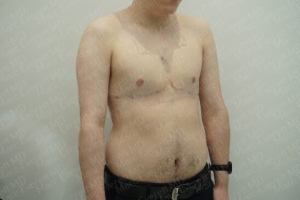Chest Masculinization Surgery Before & After Patient #3950