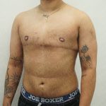 Chest Masculinization Surgery Before & After Patient #3951
