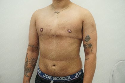 Chest Masculinization Surgery Before & After Patient #3951