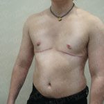 Chest Masculinization Surgery Before & After Patient #3952