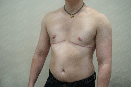 Chest Masculinization Surgery Before & After Patient #3952