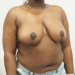 Breast Reduction Before & After Patient #3864