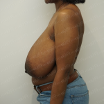 Breast Reduction Before & After Patient #3852