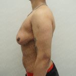 Chest Masculinization Surgery Before & After Patient #3951