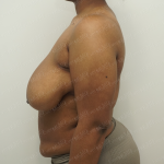 Breast Reduction Before & After Patient #3861