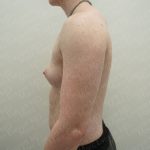 Chest Masculinization Surgery Before & After Patient #3952