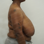 Breast Reduction Before & After Patient #3862