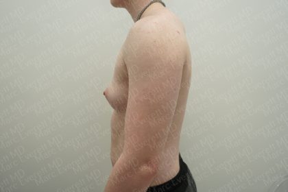 Chest Masculinization Surgery Before & After Patient #3952
