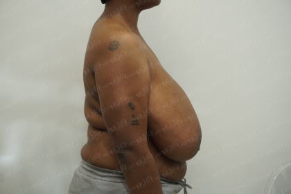 Breast Reduction Before & After Patient #3862
