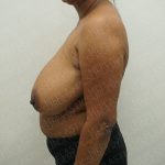 Breast Reduction Before & After Patient #3867