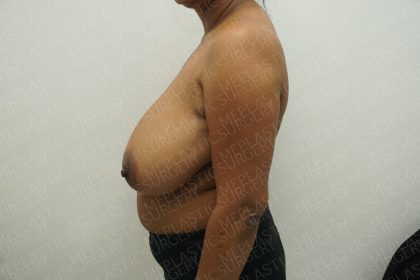 Breast Reduction Before & After Patient #3867