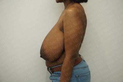 Breast Reduction Before & After Patient #3852