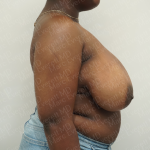 Breast Reduction Before & After Patient #3864