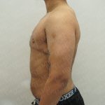 Chest Masculinization Surgery Before & After Patient #3951