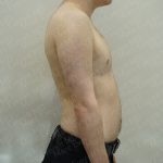 Chest Masculinization Surgery Before & After Patient #3950