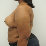 Breast Reduction Before & After Patient #3861