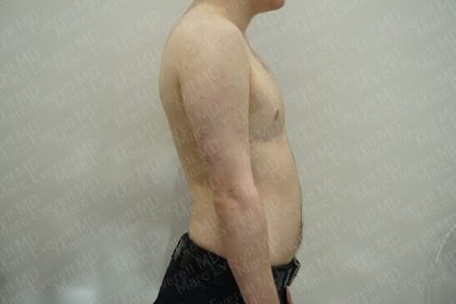 Chest Masculinization Surgery Before & After Patient #3950