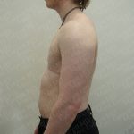 Chest Masculinization Surgery Before & After Patient #3952
