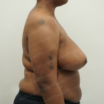 Breast Reduction Before & After Patient #3862