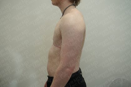 Chest Masculinization Surgery Before & After Patient #3952
