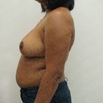 Breast Reduction Before & After Patient #3867