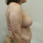 Breast Reduction Before & After Patient #3863
