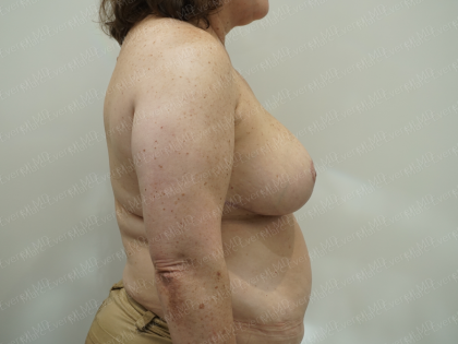 Breast Reduction Before & After Patient #3863