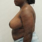 Breast Reduction Before & After Patient #3995