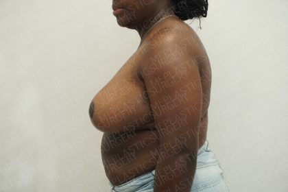 Breast Reduction Before & After Patient #3995