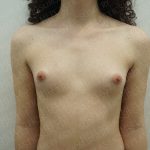 Fat Grafting Breast Augmentation Before & After Patient #4036