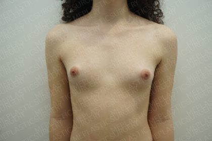 Fat Grafting Breast Augmentation Before & After Patient #4036