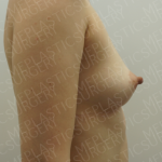 Fat Grafting Breast Augmentation Before & After Patient #4037
