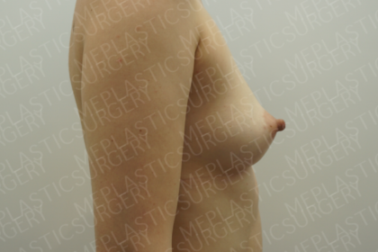 Fat Grafting Breast Augmentation Before & After Patient #4037