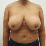 Breast Reduction Before & After Patient #4183