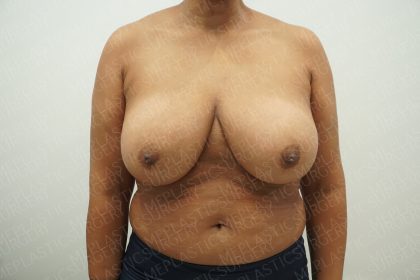Breast Reduction Before & After Patient #4183