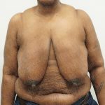 Breast Reduction Before & After Patient #4184