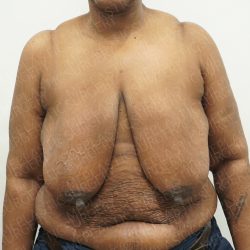 Breast Reduction Before & After Patient #4184