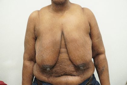 Breast Reduction Before & After Patient #4184