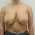 Breast Reduction Before & After Patient #4185