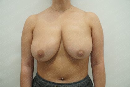 Breast Reduction Before & After Patient #4185