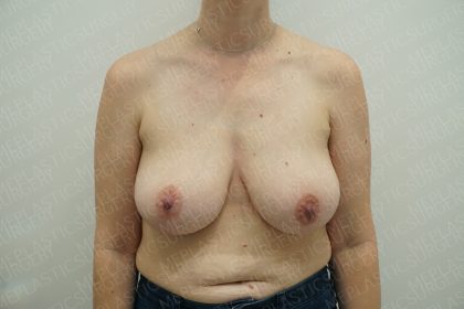 Breast Reduction Before & After Patient #4181