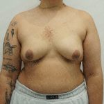Chest Masculinization Surgery Before & After Patient #4224