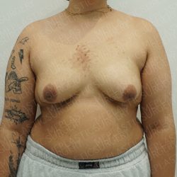 Chest Masculinization Surgery Before & After Patient #4224