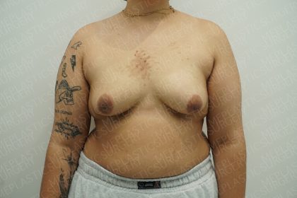 Chest Masculinization Surgery Before & After Patient #4224