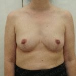 Breast Reduction Before & After Patient #4181