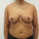 Breast Reduction Before & After Patient #4183