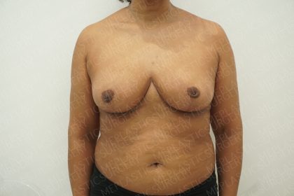 Breast Reduction Before & After Patient #4183