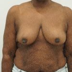 Breast Reduction Before & After Patient #4184