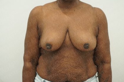 Breast Reduction Before & After Patient #4184