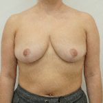Breast Reduction Before & After Patient #4185